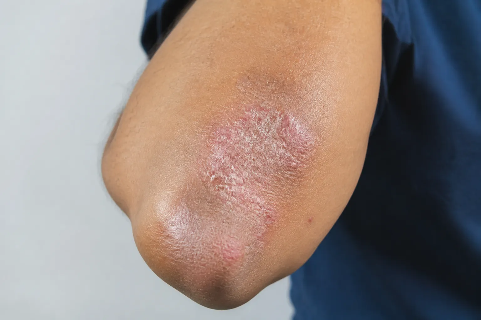Plaques — educational image for Psoriasis